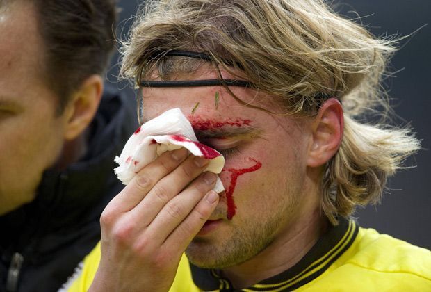 
                <strong>Marcel Schmelzer (Borussia Dortmund)</strong><br>
                Im März 2013 kommt es zum Zweikampf zwischen Stuttgarts Martin Harnik und Marcel Schmelzer. Harnik trifft den Dortmunder mit dem Fuß im Gesicht. Diagnose: Nasenbeinbruch. Trainer Jürgen Klopp nach dem Spiel: "Der Bruch ist eindeutig. Die Nase stand in alle Richtungen."
              