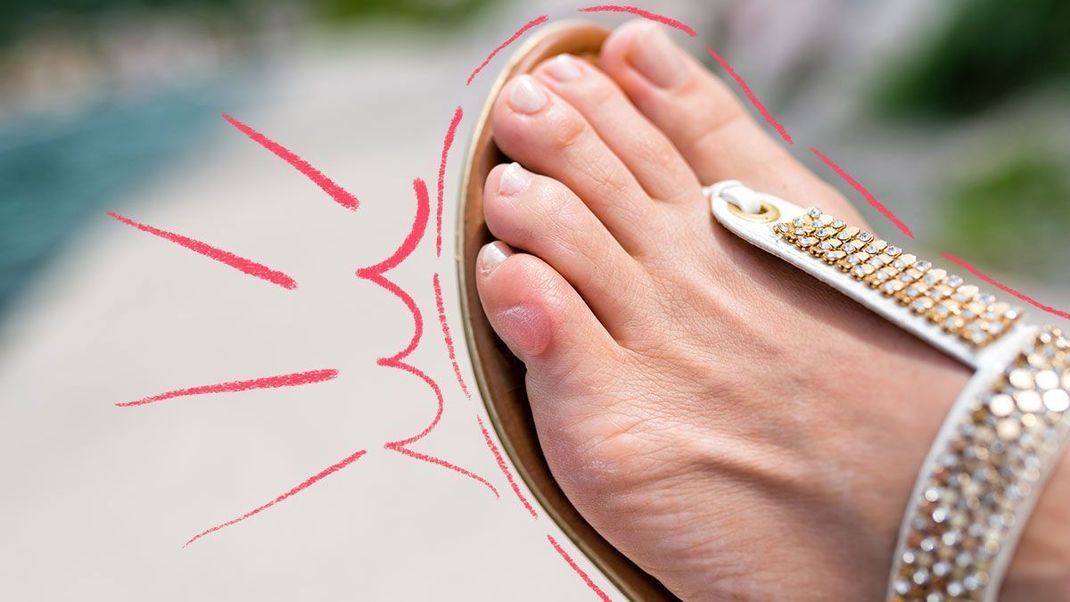 Sandalenzeit - Blasenzeit! Wir verraten euch die besten Tipps zum Vorbeugen.