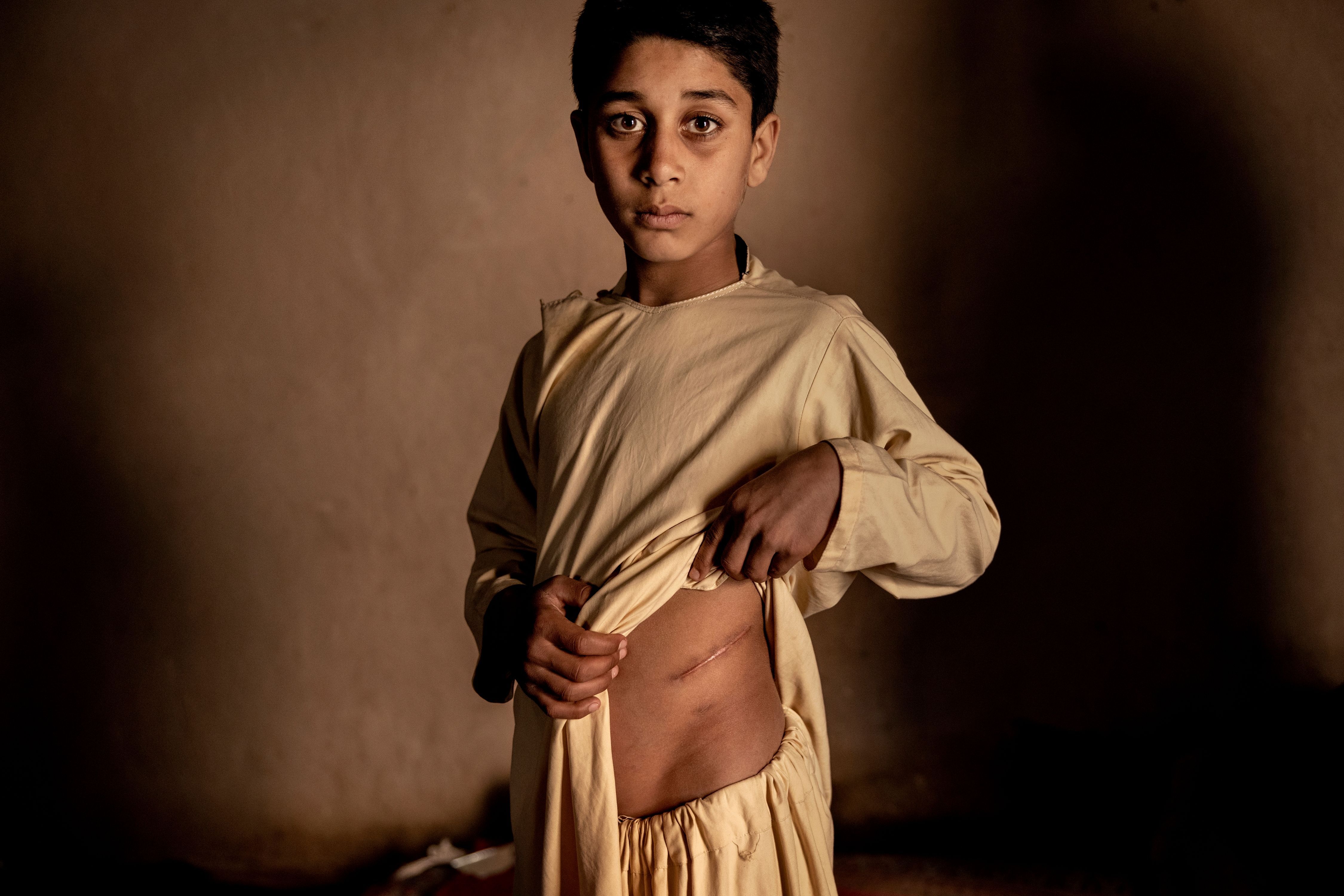 Afghanistan: Khalil Ahmads Niere wurde verkauft, um seine Familie zu unterstützen.&nbsp;