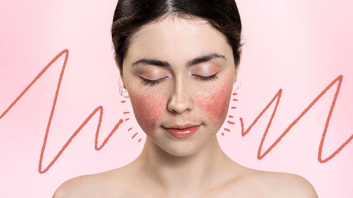 Rosacea: Hauterkrankung im Gesicht