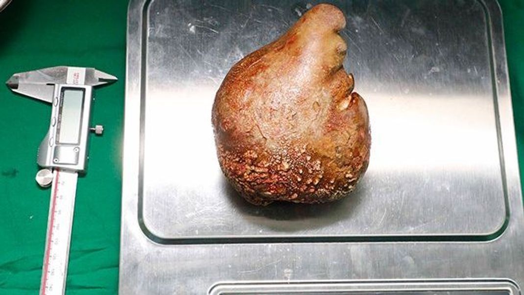 Auf Sri Lanka haben Ärzte einem Mann den bislang größten Nierenstein mit einem Gewicht von über 800 Gramm entfernt.