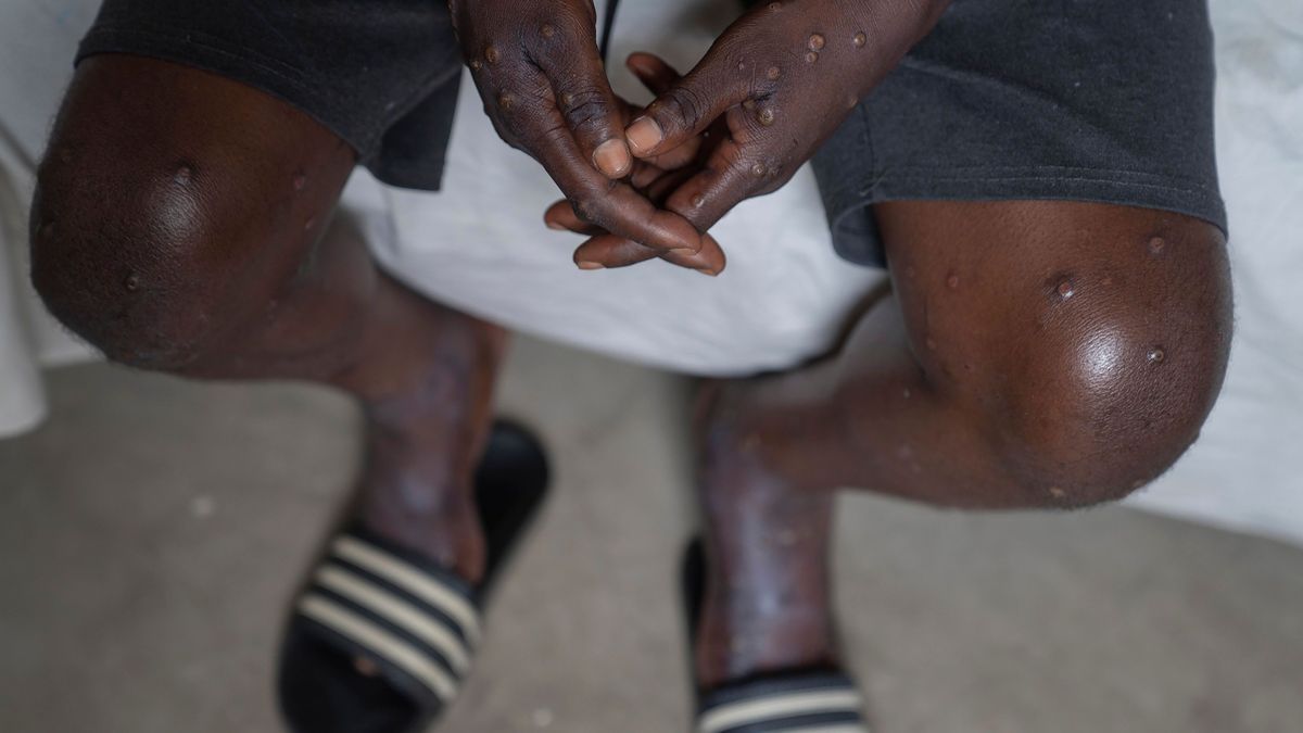 Ein mit Mpox infizierter Mann sitzt im Krankenhaus von Goma. In Schweden ist die neue Affenpocken-Variante erstmals außerhalb Afrikas nachgewiesen worden.