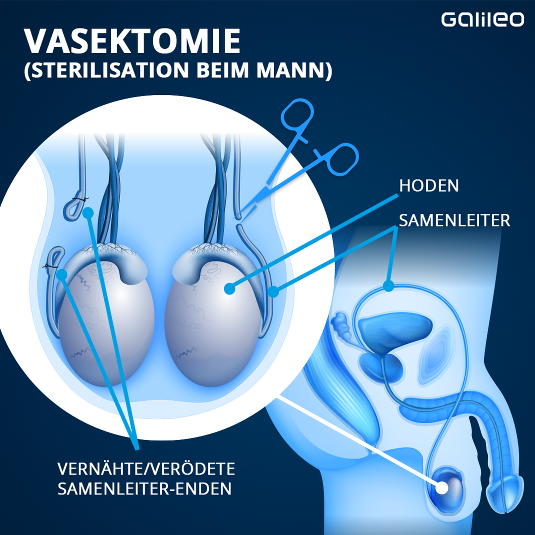 Verhütung Beim Mann Vasektomie Und Was Noch Galileo 6284