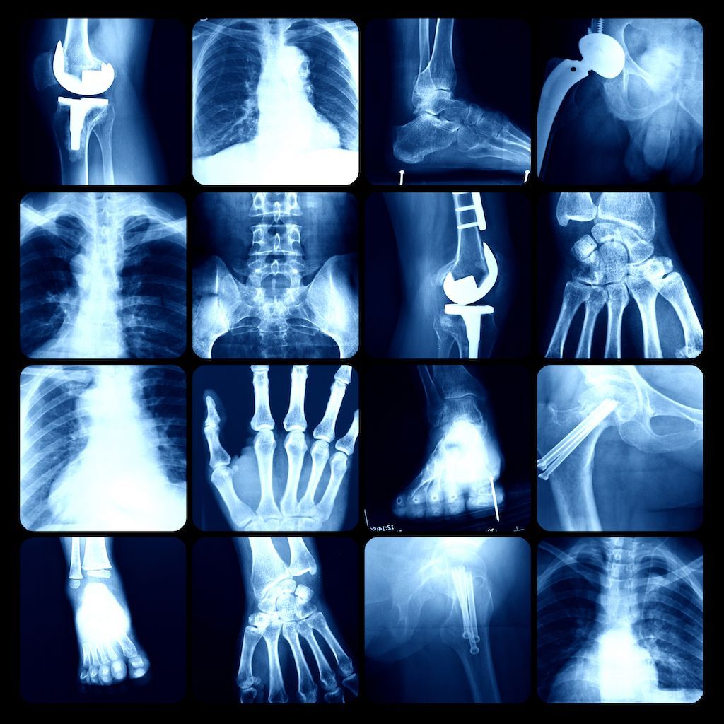 Im Jahr 1895 fällt dem Physiker Wilhelm Conrad Röntgen bei einem Versuch mit Kathodenstrahlen etwas Besonderes auf: Sie durchdringen Gegenstände. Seine "X-Strahlen" sind eine medizinische Sensation. Knochen, später auch Organe, können abgebildet und Krankheiten frühzeitig erkannt werden.