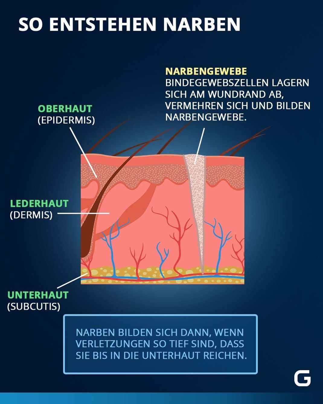 Narben bilden sich dann, wenn Verletzungen so tief sind, dass sie bis in die Unterhaut reichen.