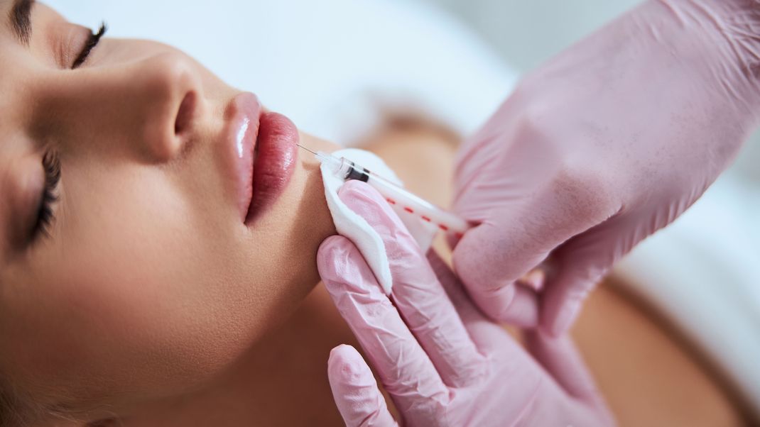 Lippen aufspritzen mit Hyaluronsäure: Was steckt hinter dem Beauty