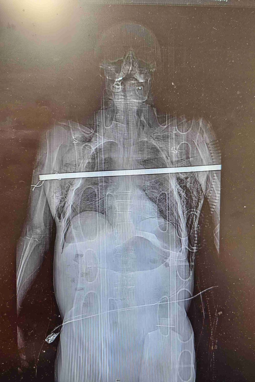 Auf einem Röntgenbild ist die Eisenstange zu sehen, die sich durch den Oberkörper des 59-jährigen Radovan Kučera aus Bochor (Tschechien) gebohrt hatte.