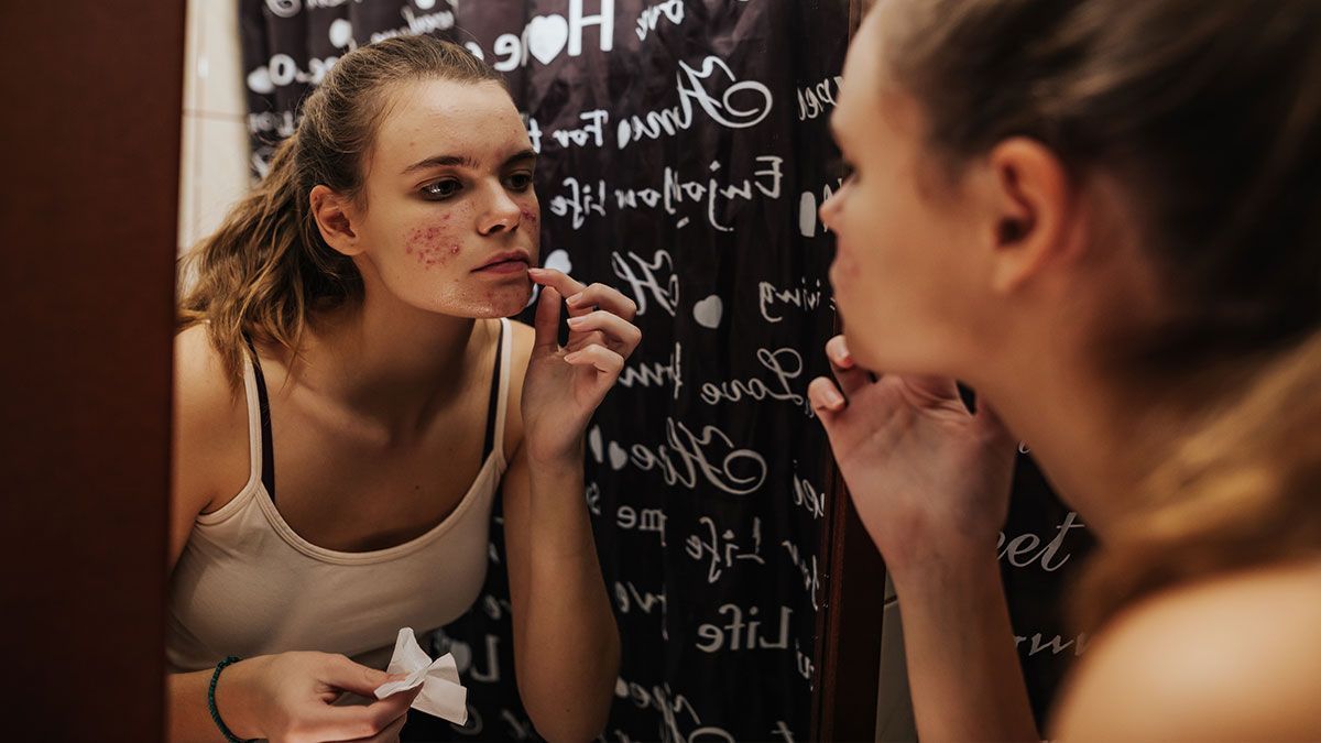 Akne: Hautproblem, aber auch psychische Belastung für viele von uns. Wir sagen: Schluss damit! Und zeigen, warum du dich bei Hautproblemen – wie Akne – nicht mehr verstecken solltest. 