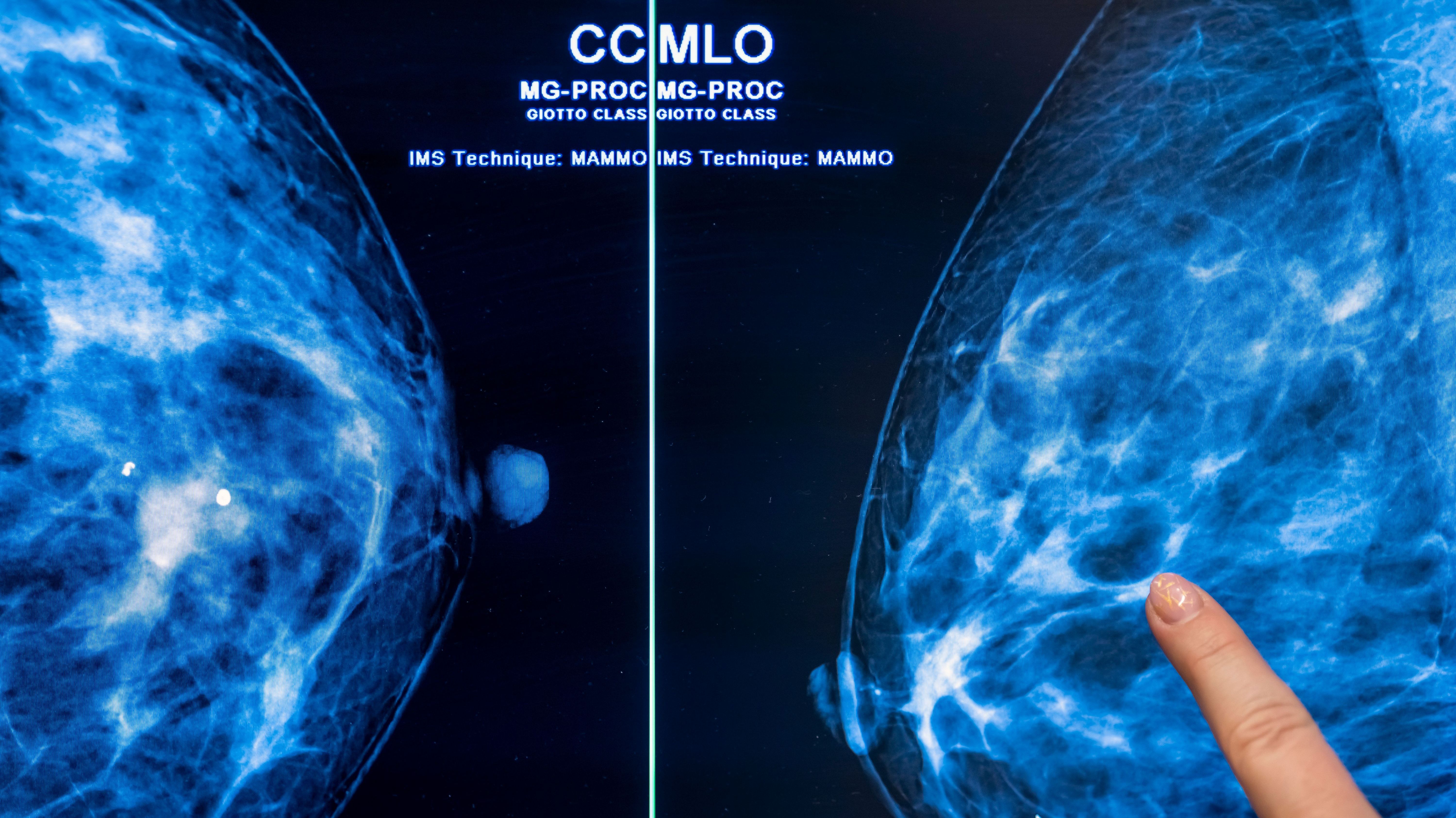 Die Mammografie der Brust einer Frau auf Brustkrebs wird wohl noch lange nicht ausgedient haben. Allerdings könnte es einen Durchbruch in der Forschung gegeben haben. Die Wissenschaftlerin Simona Francese fand heraus, dass sich anhand des Fingerabdrucks frühzeitig Brustkrebs erkennen ließe.