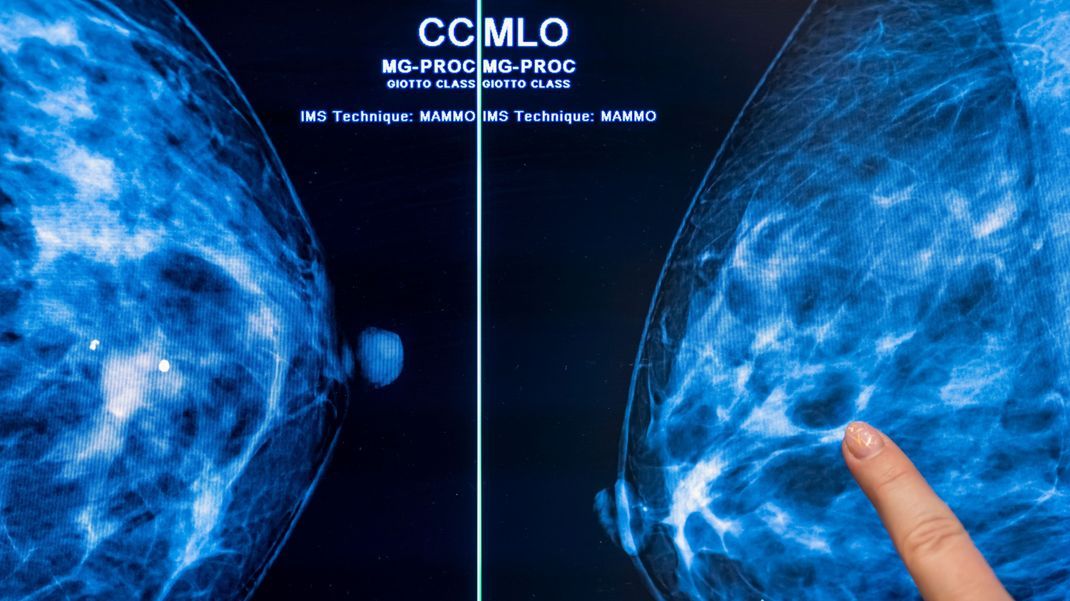Die Mammografie der Brust einer Frau auf Brustkrebs wird wohl noch lange nicht ausgedient haben. Allerdings könnte es einen Durchbruch in der Forschung gegeben haben. Die Wissenschaftlerin Simona Francese fand heraus, dass sich anhand des Fingerabdrucks frühzeitig Brustkrebs erkennen ließe.
