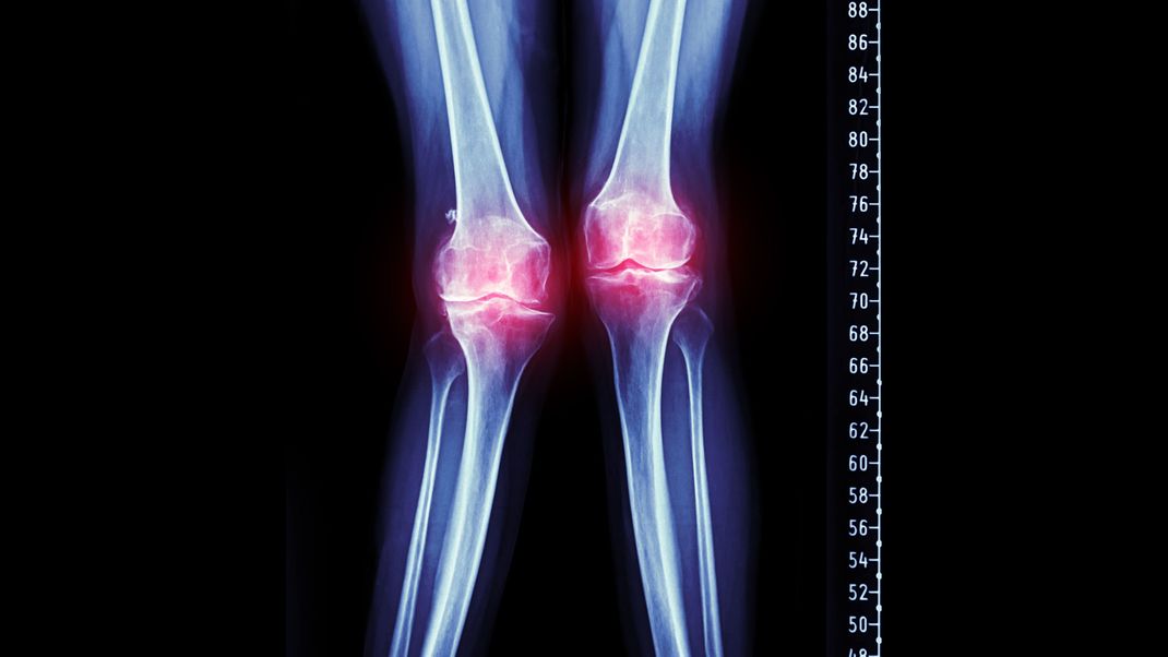 Rachitis, auch Armen-Krankheit, sorgt aufgrund von schlechter Ernährung und Vitamin-D-Mangel für deformierte Knochen.