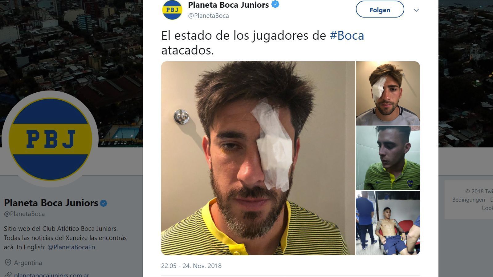 
                <strong>Boca-Spieler wurden verletzt</strong><br>
                Einige Spieler der Boca Juniors trugen Schnittwunden und andere Verletzungen davon - in Folge des Kontakts mit dem Tränengas hatten sie weitere gesundheitliche Probleme.Im Stadion angekommen mussten die Spieler der Juniors von den Teamärzten behandelt werden. Stürmerstar Carlos Tevez bekam das Tränengas voll ab und musste sich demnach mehrmals übergeben.
              