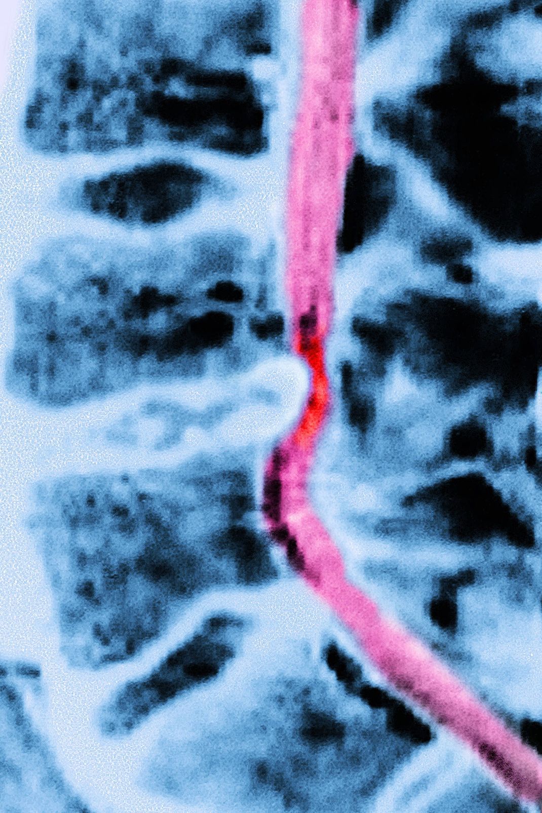 MRI-Aufnahme (Magnetresonanztomographie) der Wirbelsäule: Eine Bandscheibe drückt auf das Rückenmark.