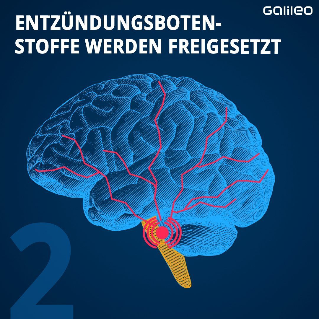 Bei Migräne werden Entzündungsbotenstoffe freigesetzt.