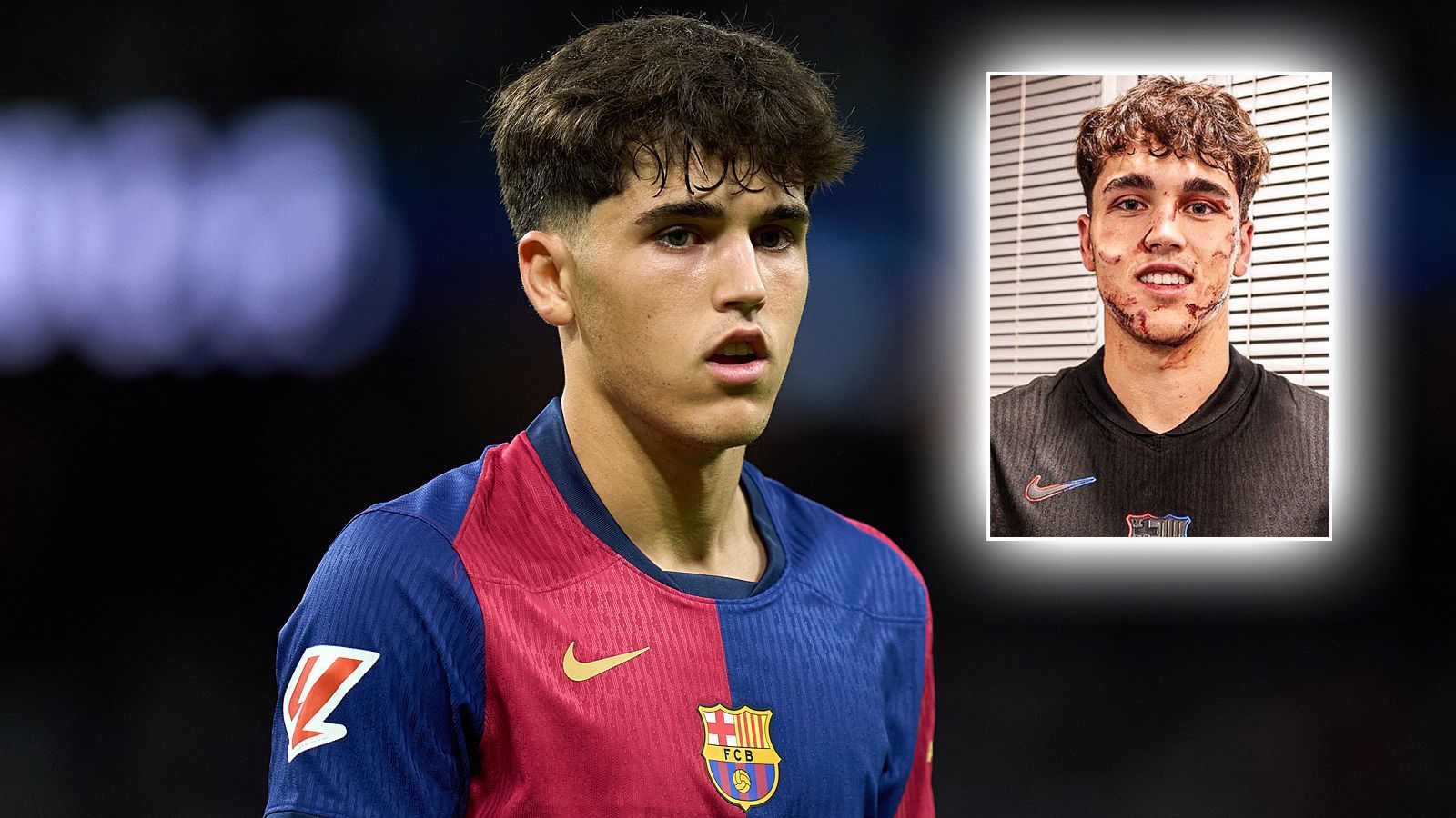 <strong>Pau Cubarsi: Champions League, 2024: Roter Stern - FC Barcelona</strong><br>Beim 5:2-Sieg des FC Barcelona in Belgrad musste Talent Pau Cubarsi vorzeitig vom Feld  und das aus gutem Grund. Der 17-Jährige bekam einen Tritt von Gegenspieler Uros Spajic gegen den Kopf. Die Folge: Ein komplett lädiertes Gesicht, mehrere blutenden Stellen. Es brauchte zehn Stiche, um alle Wunden Cubarsis zu schließen.