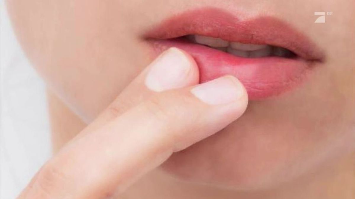 SOS-Mittel gegen Herpes
