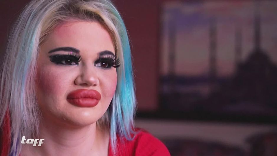 Barbie: Diese Studentin schockt mit XXL-Lippen