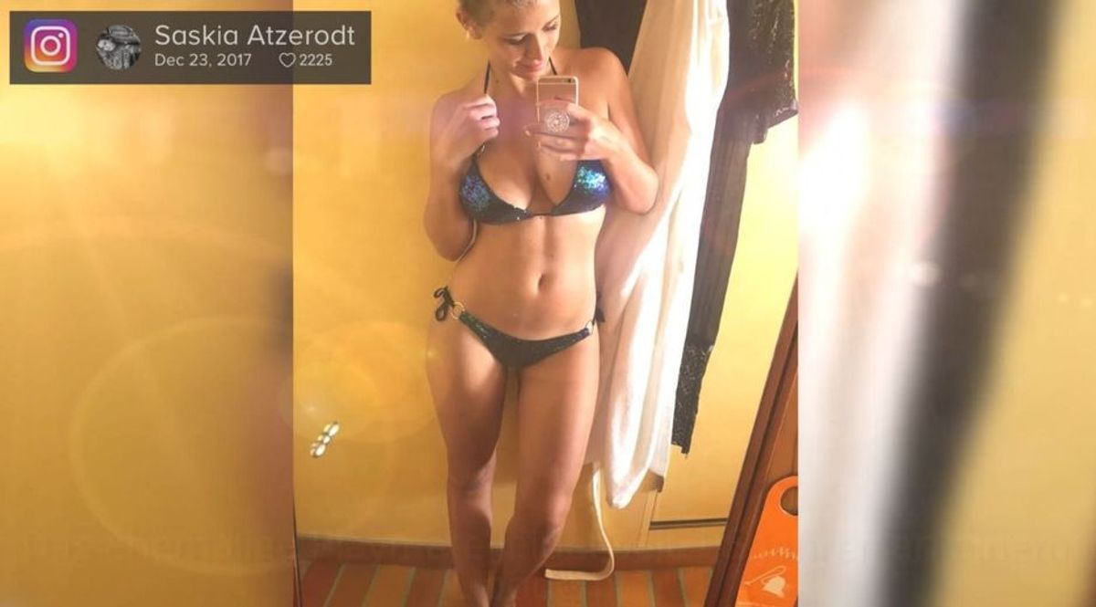Schweres Schicksal: Saskia Atzerodt leidet unter einem Lipödem