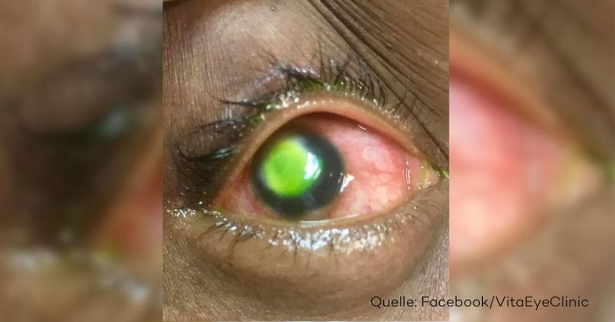 Horror-Bilder vom Auge einer Frau: Bakterien zerfressen Hornhaut