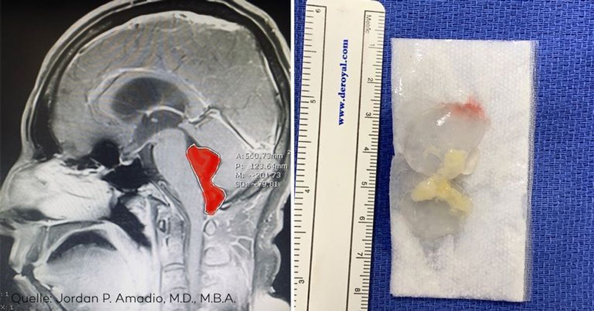 Nach schrecklichen Kopfschmerzen: Bandwurm aus Gehirn entfernt