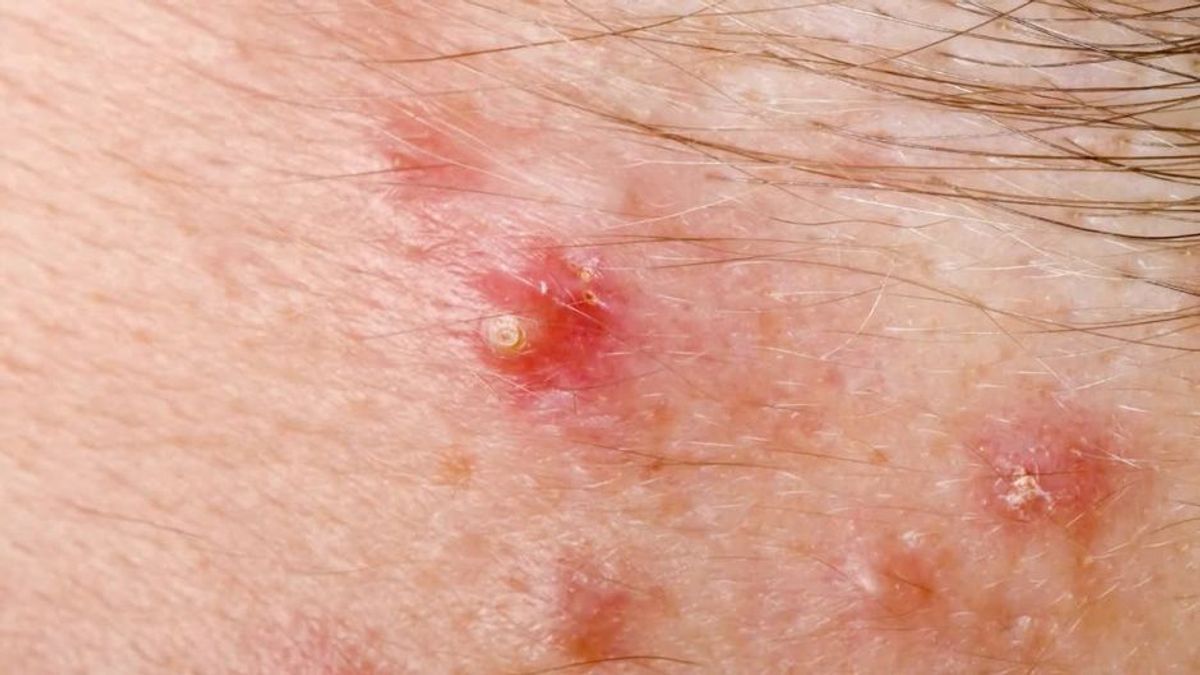 Sommer, Sonne – Hitzepickel: Das hilft schnell gegen die unschönen Bläschen