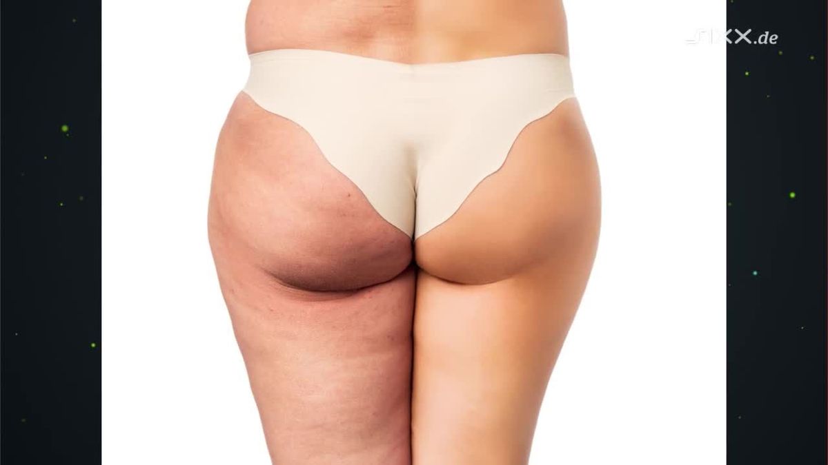 Deshalb bekommst du Cellulite