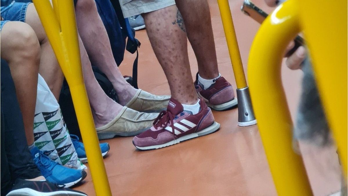 Foto geht viral: Mann mit ansteckenden Affenpocken in U-Bahnv