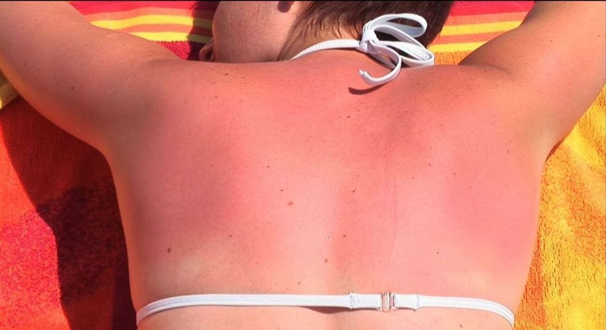 SOS-Tipps: Das hilft wirklich bei Sonnenbrand