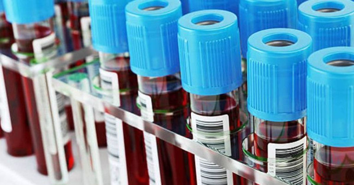 Medizinische Sensation: Forscher können Blutgruppen A und B in 0 umwandeln