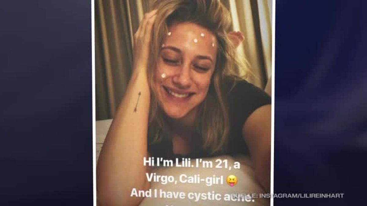 Lili Reinhart: “Riverdale”-Star leidet an zystischer Akne