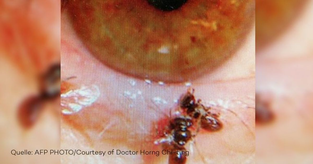 Doktor findet lebende Bienen im Auge einer Frau