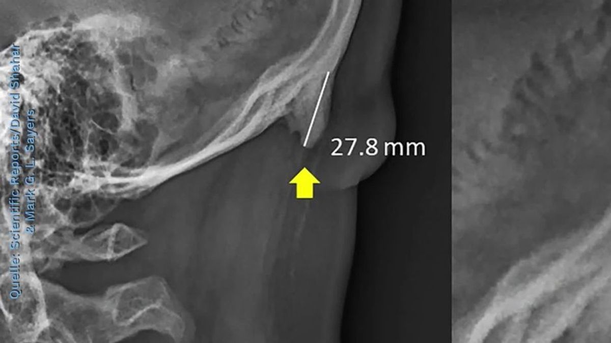 Röntgenbilder zeigen: Smartphone-Nutzern wachsen Hörner am Hinterkopf