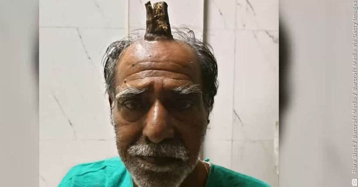 Kopf angeschlagen: Mann wächst 10-Zentimeter-"Teufelshorn"