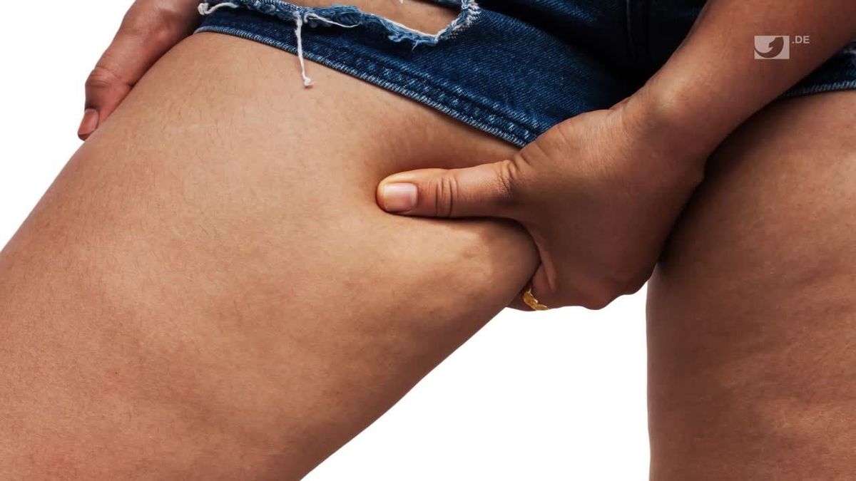 Deshalb bekommt ihr Cellulite - was wirklich dagegen hilft