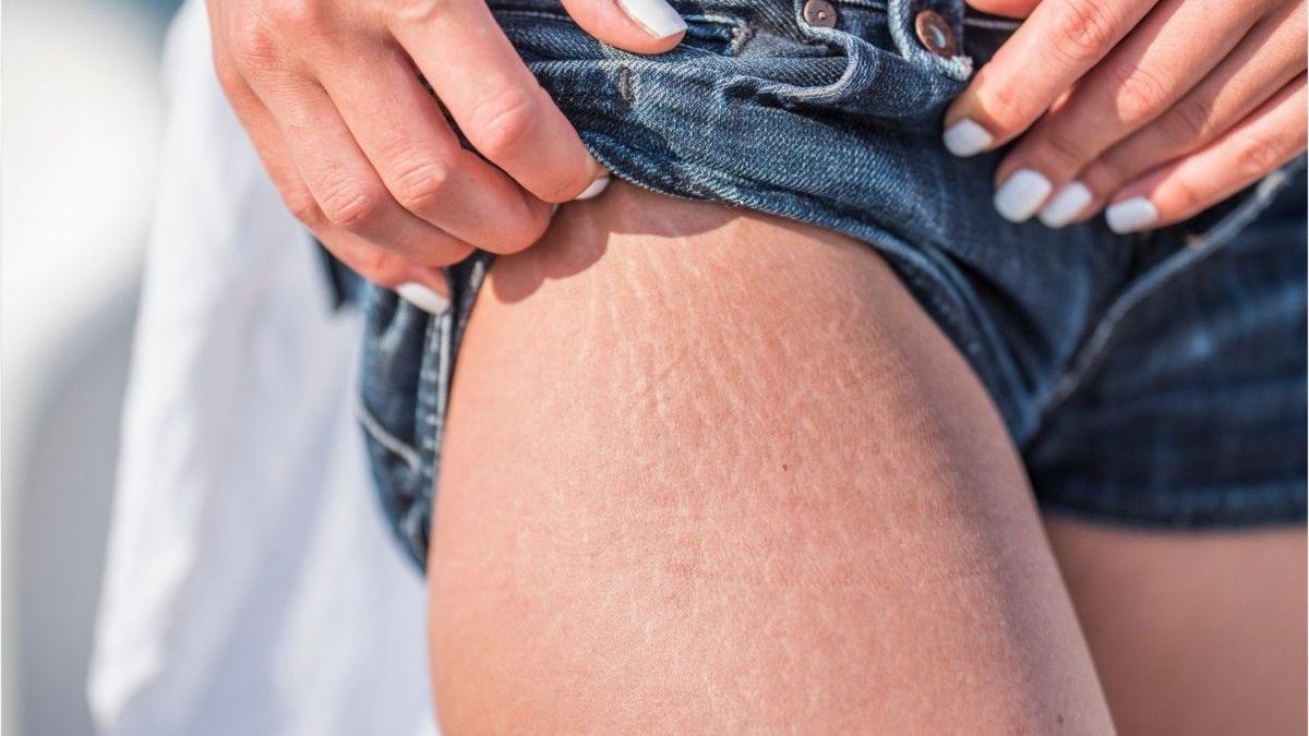 Sport gegen Dehnungsstreifen: Das hilft wirklich