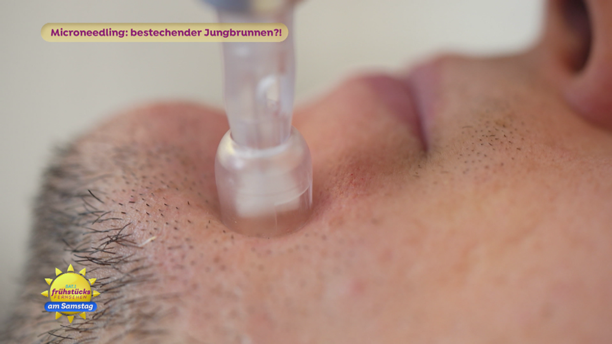 Microneedling: Jungbrunnen für die Haut?