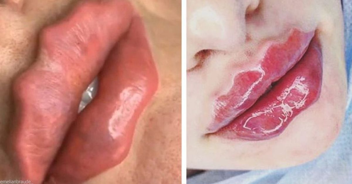 Neuer Trend: Mund aufspritzen in Zackenform