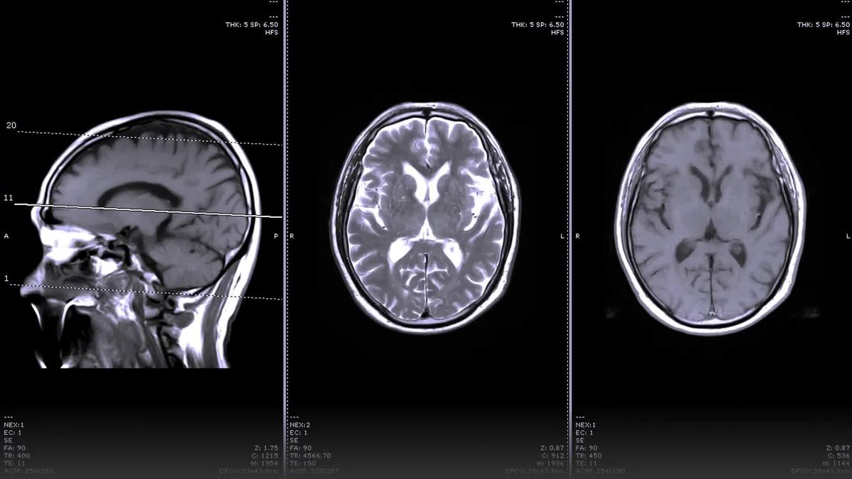 Bis zu zehn Jahre vor Ausbruch: Künstliche Intelligenz kann Alzheimer früher erkennen