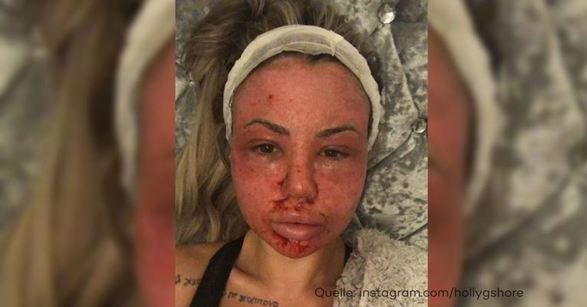 Reality-Star Holly Hagan nach Schönheits-Eingriff komplett entstellt