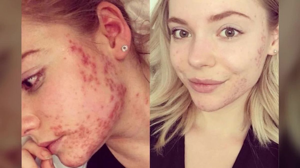 Diese junge Frau hat auf ein Lebensmittel verzichtet und damit ihre schlimme Akne geheilt