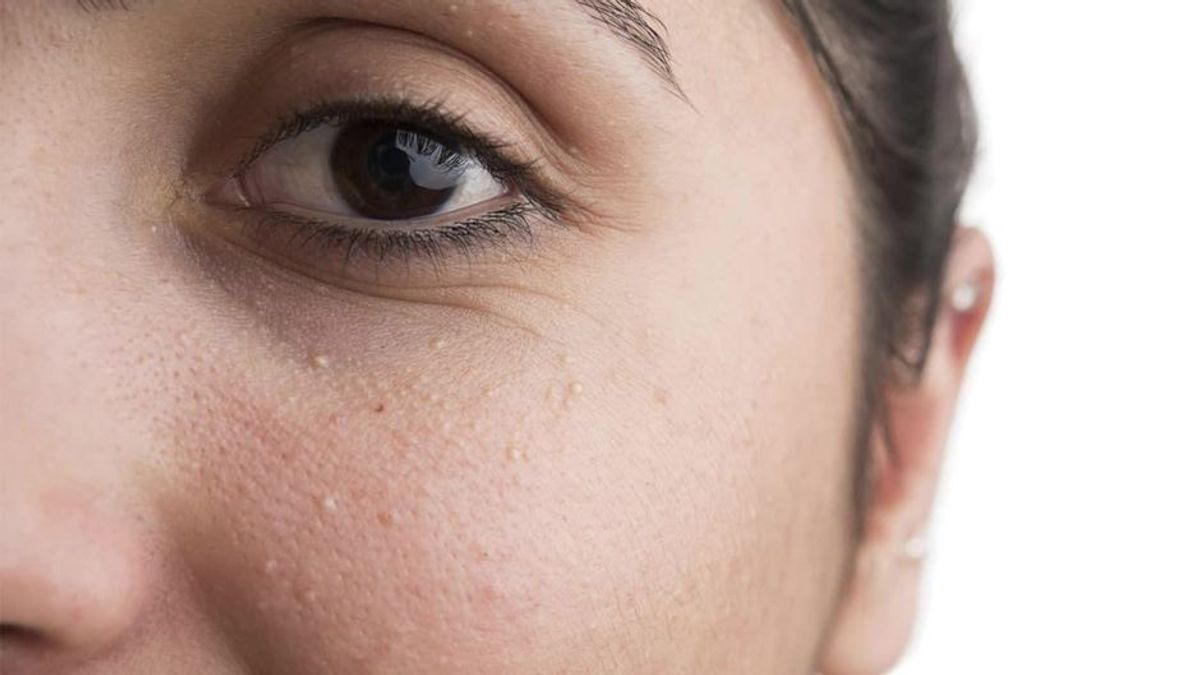 Kleine weiße Pickelchen im Gesicht? Das hilft dagegen