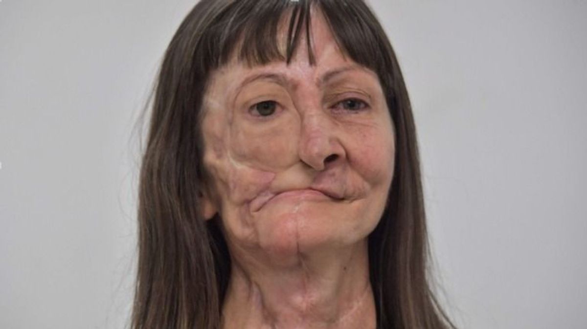 Nach Krebs-Erkrankung: Frau bekommt neues Gesicht aus dem 3D-Drucker